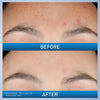 Resurfacing Retinol Serum, Pore Minimizer & Brightening Formula, for Post-Acne Skin