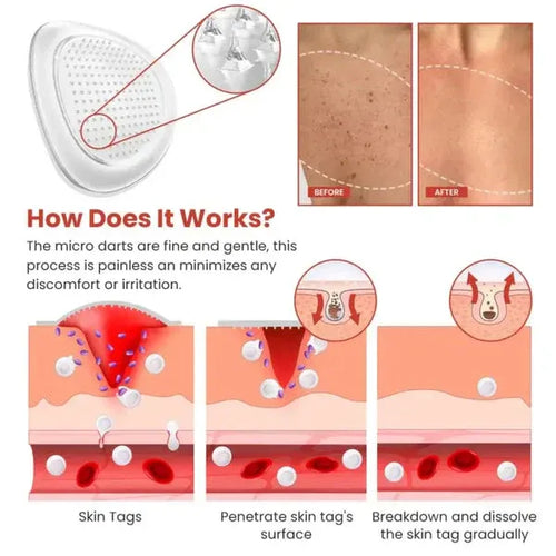 DermaSmooth Herbal Hydrocolloid Skin Tag Removal Patches