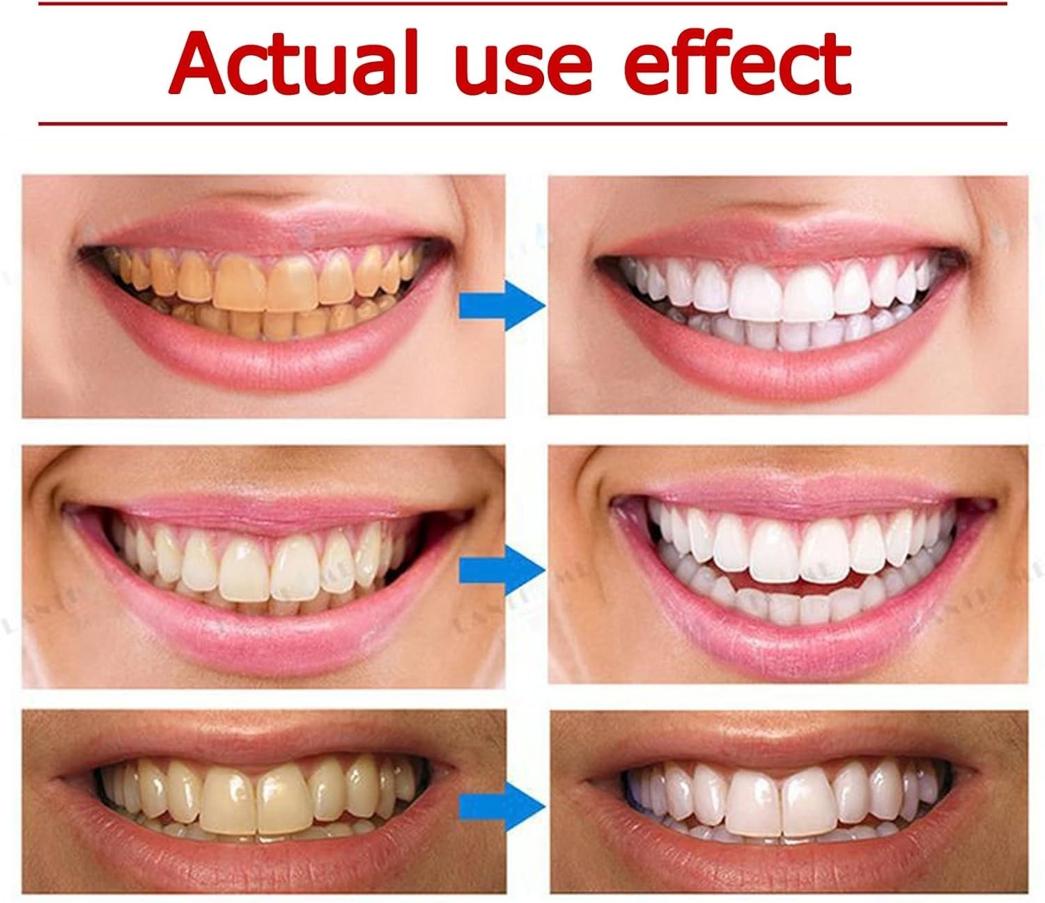 Yayashi SP-4 Ultra Whitening Toothpaste – 150ml Probiotic Stain Remover for Bright,