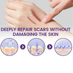 IMILK Scarvanisher Scar Gel 30g | Advanced Scar & Stretch Marks Removal Cream | Fast-Absorbing Skin Repair Gel