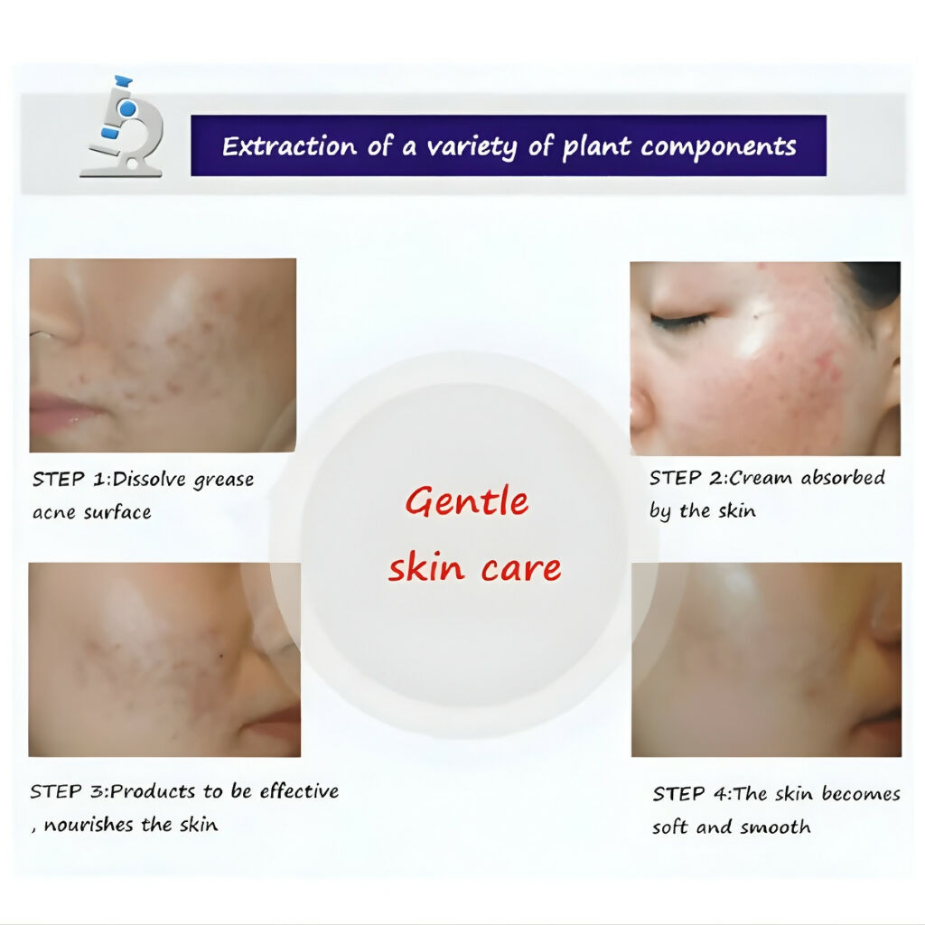 BIOAQUA Anti Acne Cleanser For Removal Of Acne - 100ml