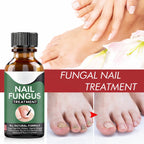 Fungal Nail Treatment, Repair Solution for Damaged and Discolored Nails