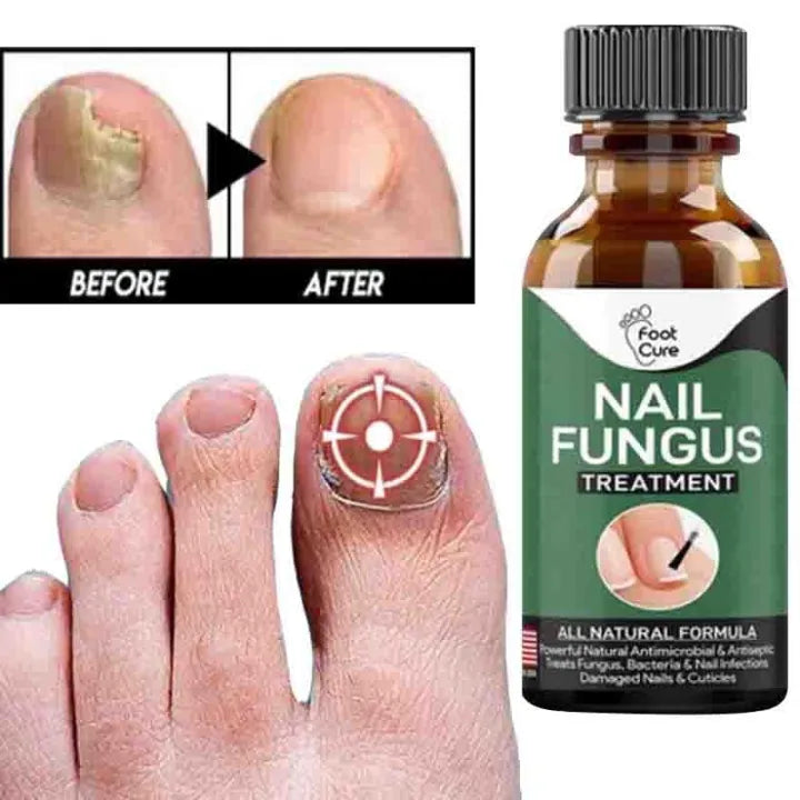 Fungal Nail Treatment, Repair Solution for Damaged and Discolored Nails