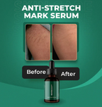 Markaway Stretch Mark Serum Herbal Formula for Scars & Skin Elasticity