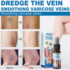 30ml Varicose Veins Treatment Spray Varicose Vein Treatment Cream Repair Varicocele Removal Pain Relief Kidney Inflammation Legs Vein Health Care Spray