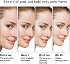 Aichun Beauty Anti - Acne Whitening Facial Serum Aloe Vera Extract Salicylic Acid Repairs Damaged Skin | 30ml