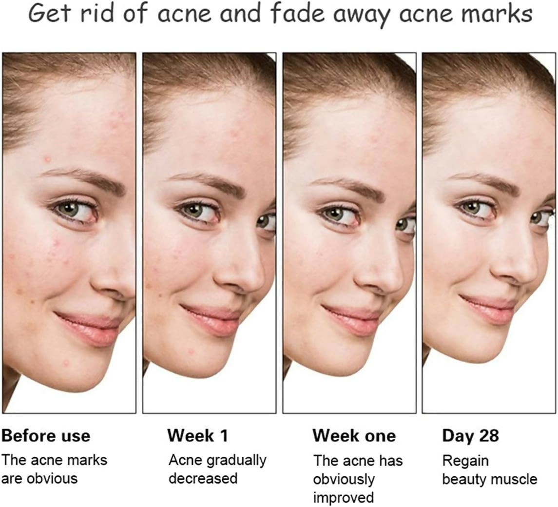 Aichun Beauty Anti - Acne Whitening Facial Serum Aloe Vera Extract Salicylic Acid Repairs Damaged Skin | 30ml